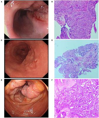 Case Report: Triple Primary Malignant Tumors of the Esophagus, Stomach, and Colon in a Patient With Genetic Analysis